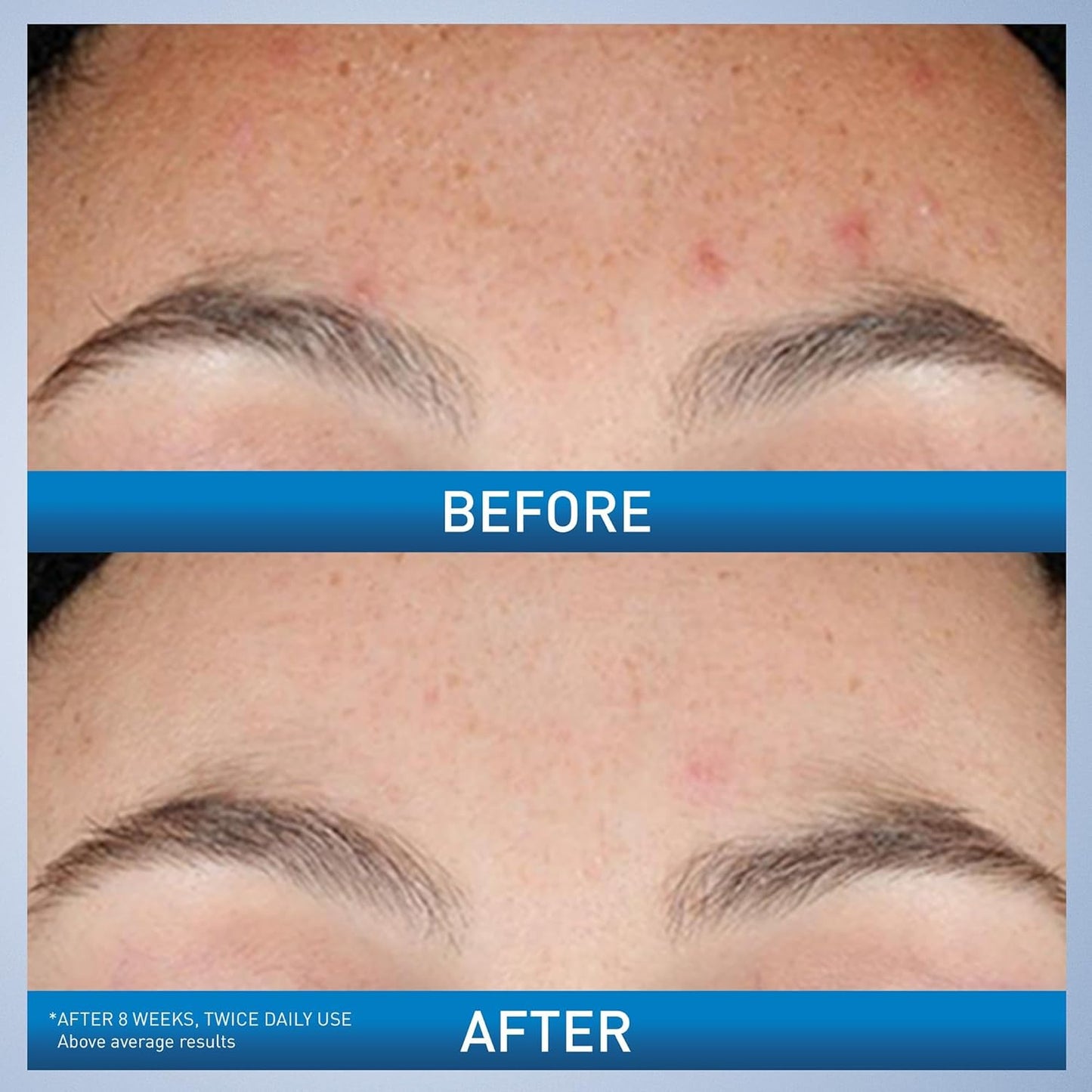CeraVe Resurfacing Retinol Serum For Post Acne Marks, Formulated With 