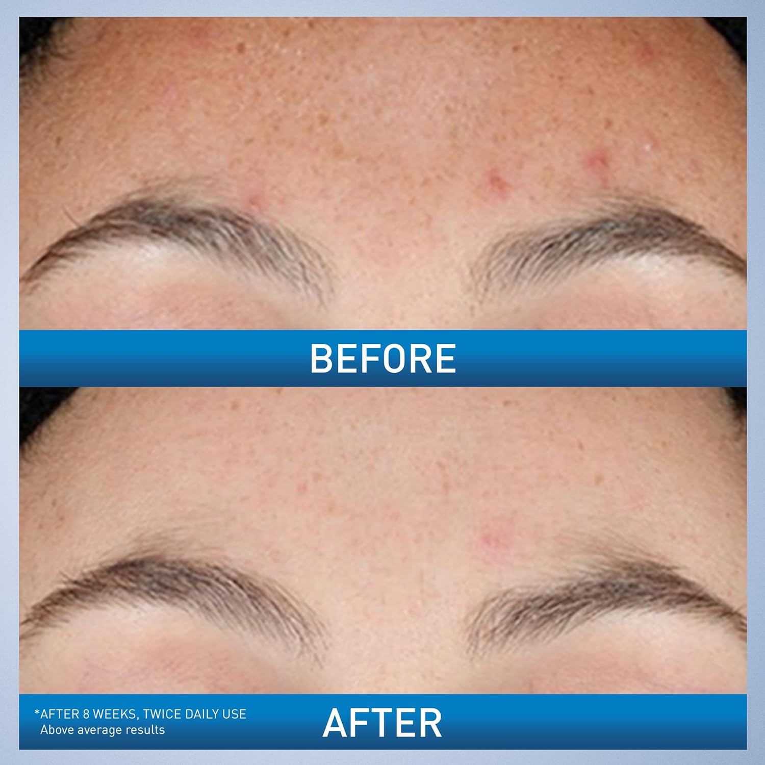 CeraVe Resurfacing Retinol Serum For Post Acne Marks, Formulated With 
