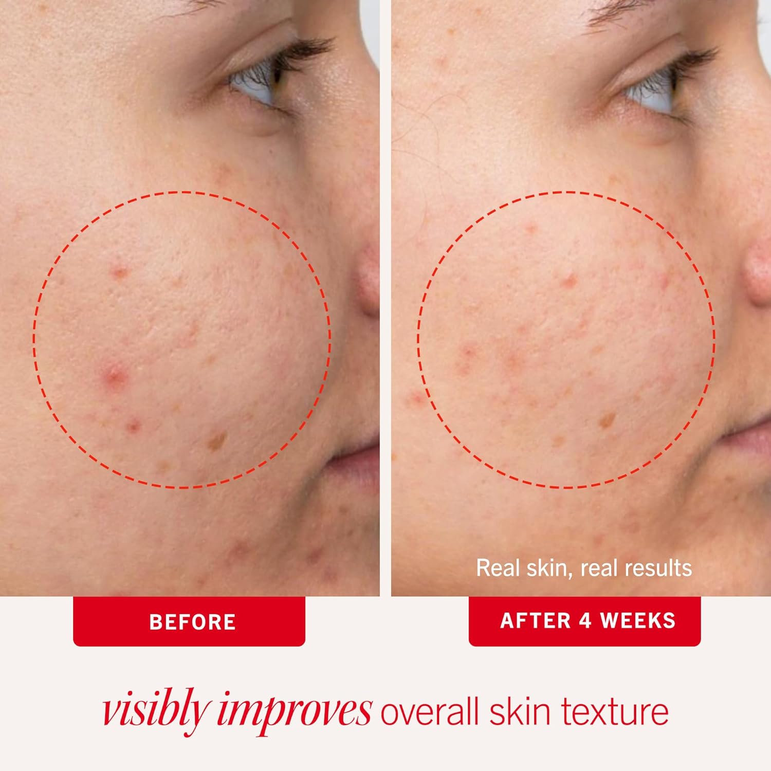 First Aid Beauty Acne Pads for Face - Maximum Strength Acne Treatment 