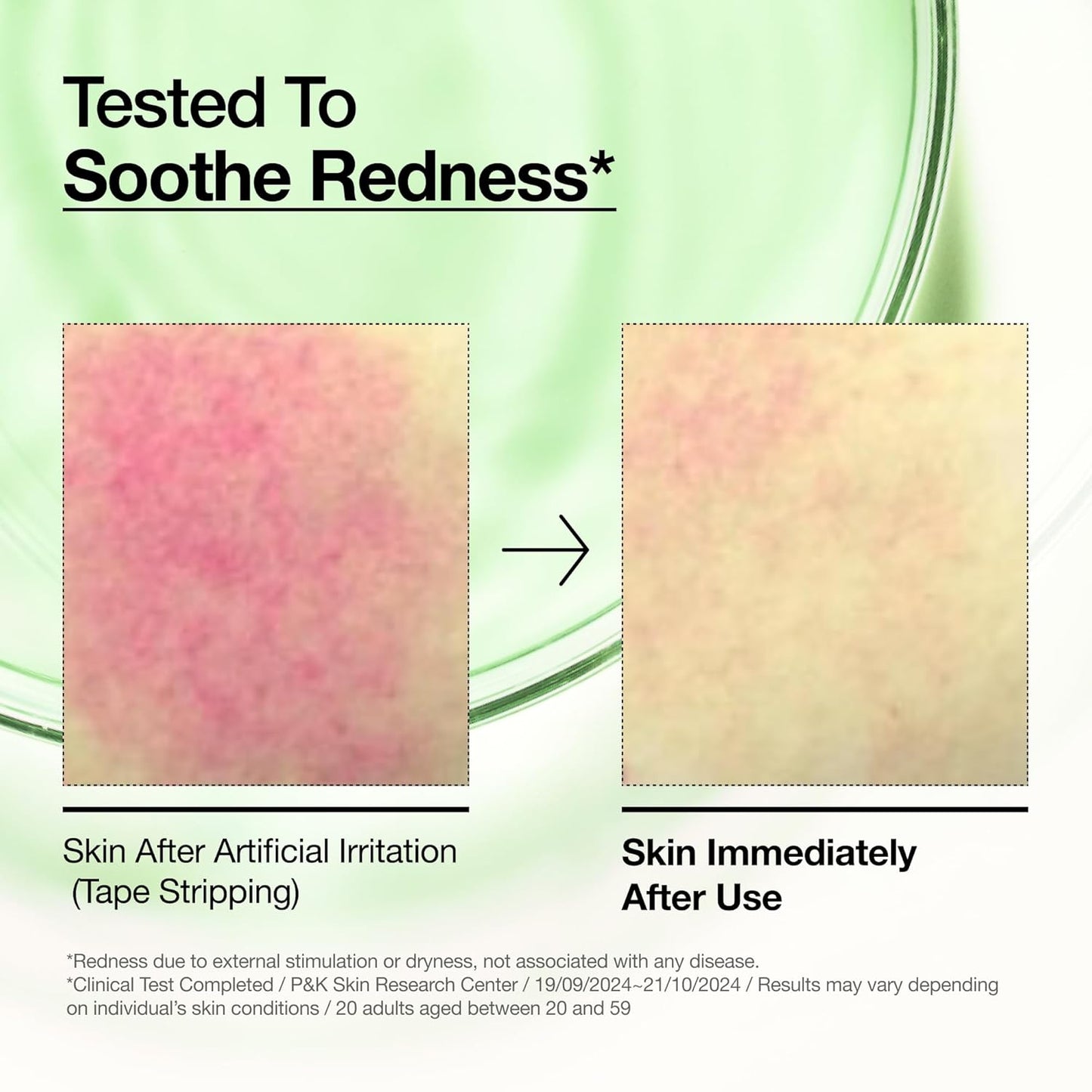 Anua Azelaic Acid 10 Hyaluron Redness Soothing Serum, Facial Serum for