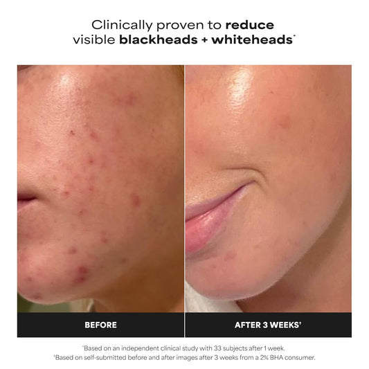 Paula's Choice SKIN PERFECTING 2% BHA Liquid Exfoliant with Salicylic 