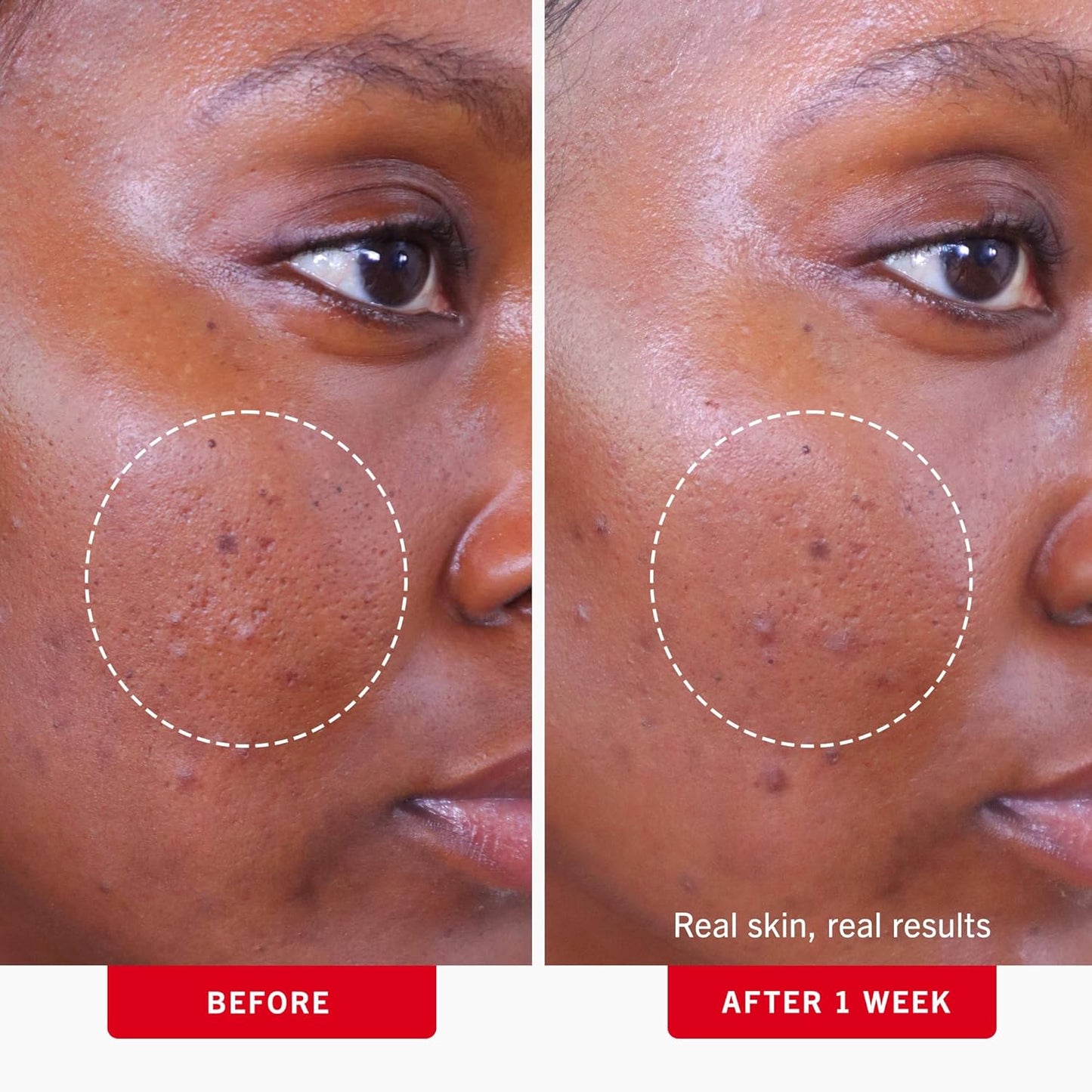 First Aid Beauty Acne Pads for Face - Maximum Strength Acne Treatment 