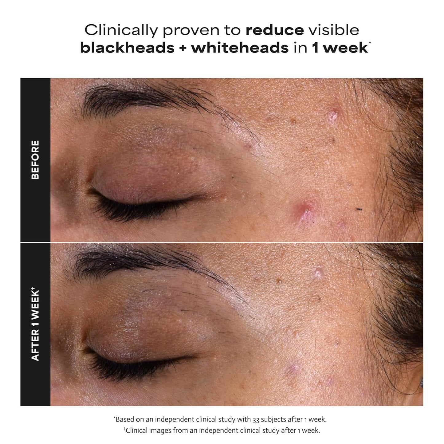 Paula's Choice SKIN PERFECTING 2% BHA Liquid Exfoliant with Salicylic 