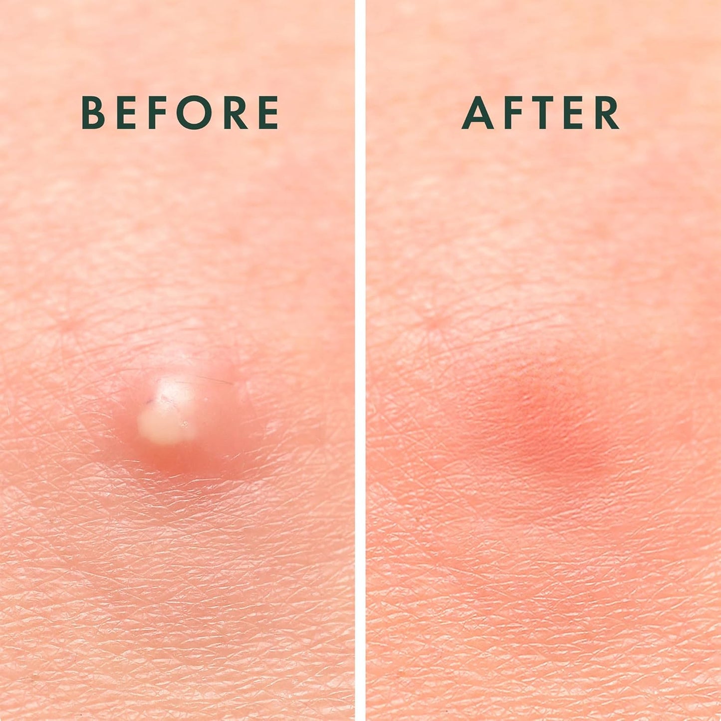 Rael Pimple Patches, Miracle Invisible Spot Cover - Hydrocolloid Acne 