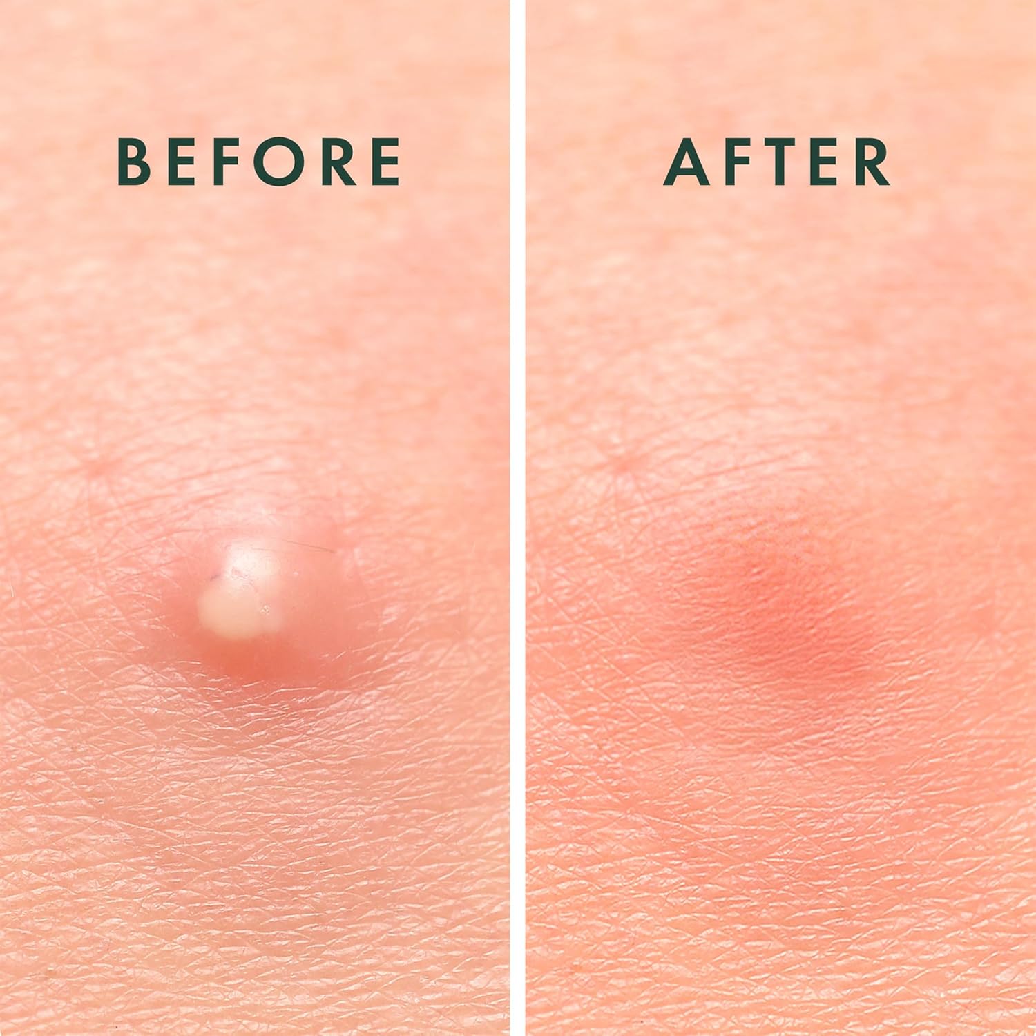 Rael Pimple Patches, Miracle Invisible Spot Cover - Hydrocolloid Acne 