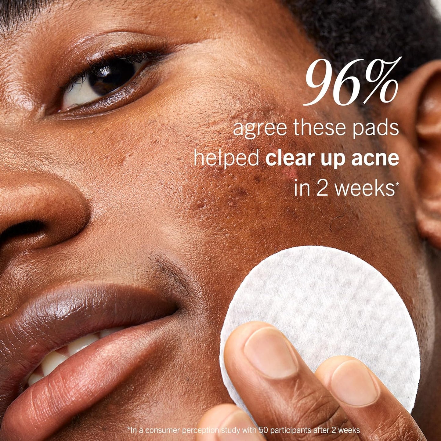 First Aid Beauty Acne Pads for Face - Maximum Strength Acne Treatment 