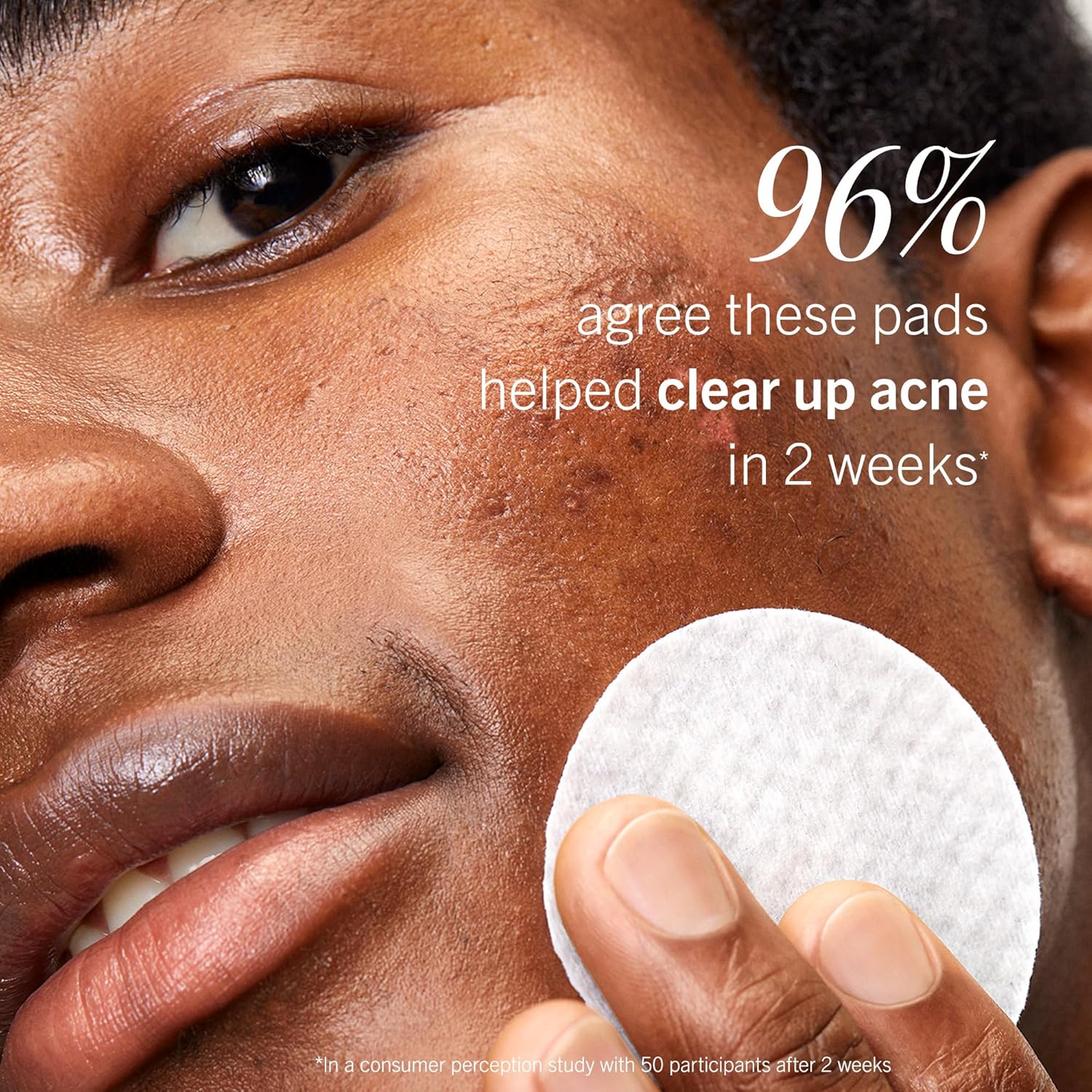 First Aid Beauty Acne Pads for Face - Maximum Strength Acne Treatment 